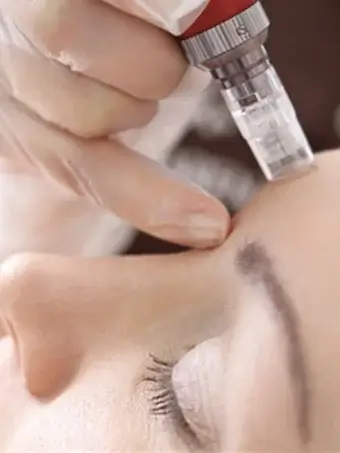MICRONEEDLING