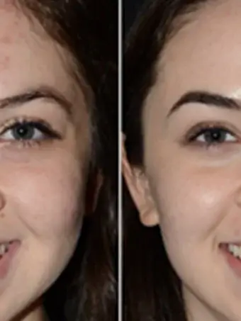 Teenager Facial